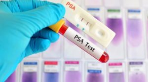Come interpretare il PSA Test