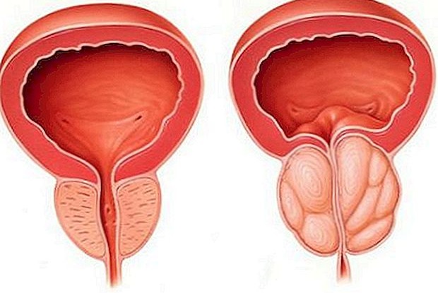 iperplasia prostatica benigna Prosztata táplálkozás kezelése